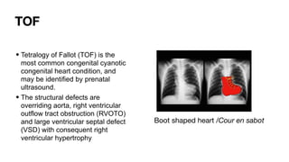Comprehensive Interpretation of Cardiac Shadow on Chest X-Ray | PDF