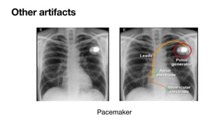 Comprehensive Interpretation of Cardiac Shadow on Chest X-Ray | PDF