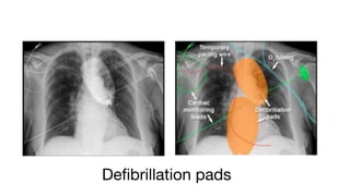 Comprehensive Interpretation of Cardiac Shadow on Chest X-Ray | PDF
