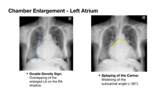 Comprehensive Interpretation of Cardiac Shadow on Chest X-Ray | PDF