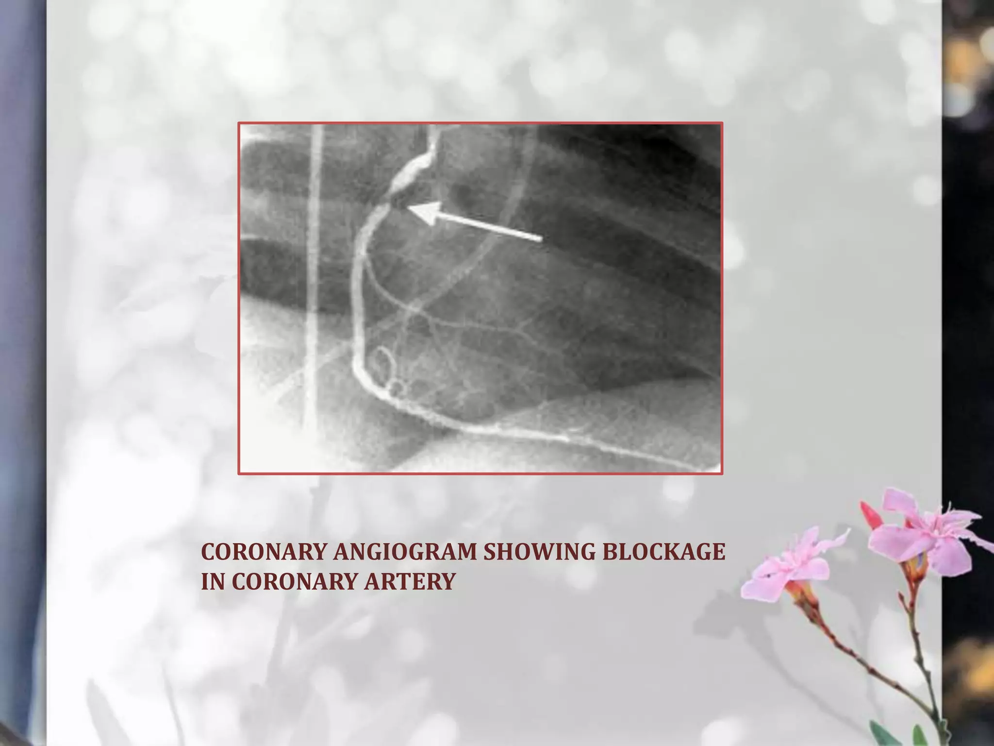 CORONARY ANGIOGRAM SHOWING BLOCKAGE
IN CORONARY ARTERY

 