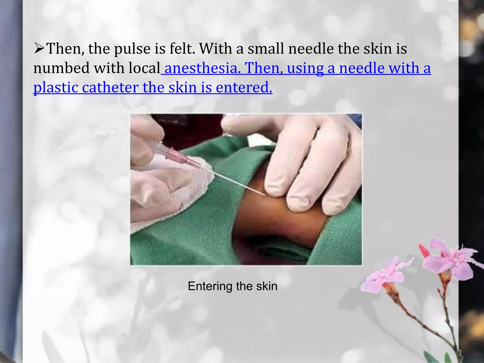 Then, the pulse is felt. With a small needle the skin is
numbed with local anesthesia. Then, using a needle with a
plastic catheter the skin is entered.

Entering the skin

 