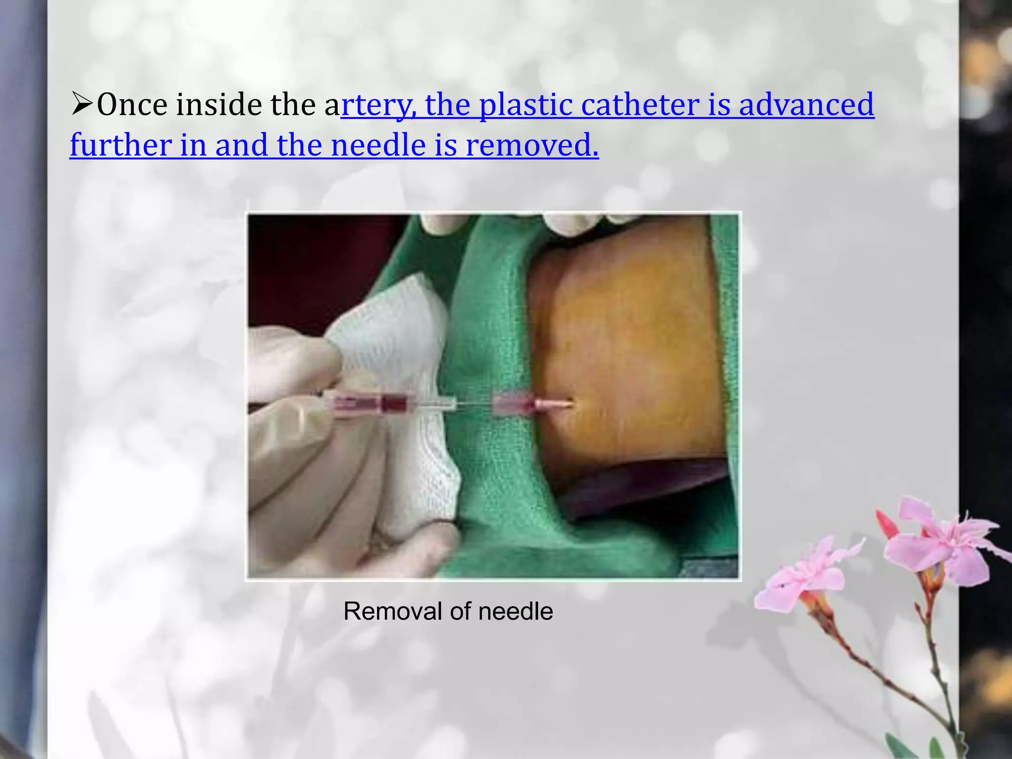 Once inside the artery, the plastic catheter is advanced
further in and the needle is removed.

Removal of needle

 