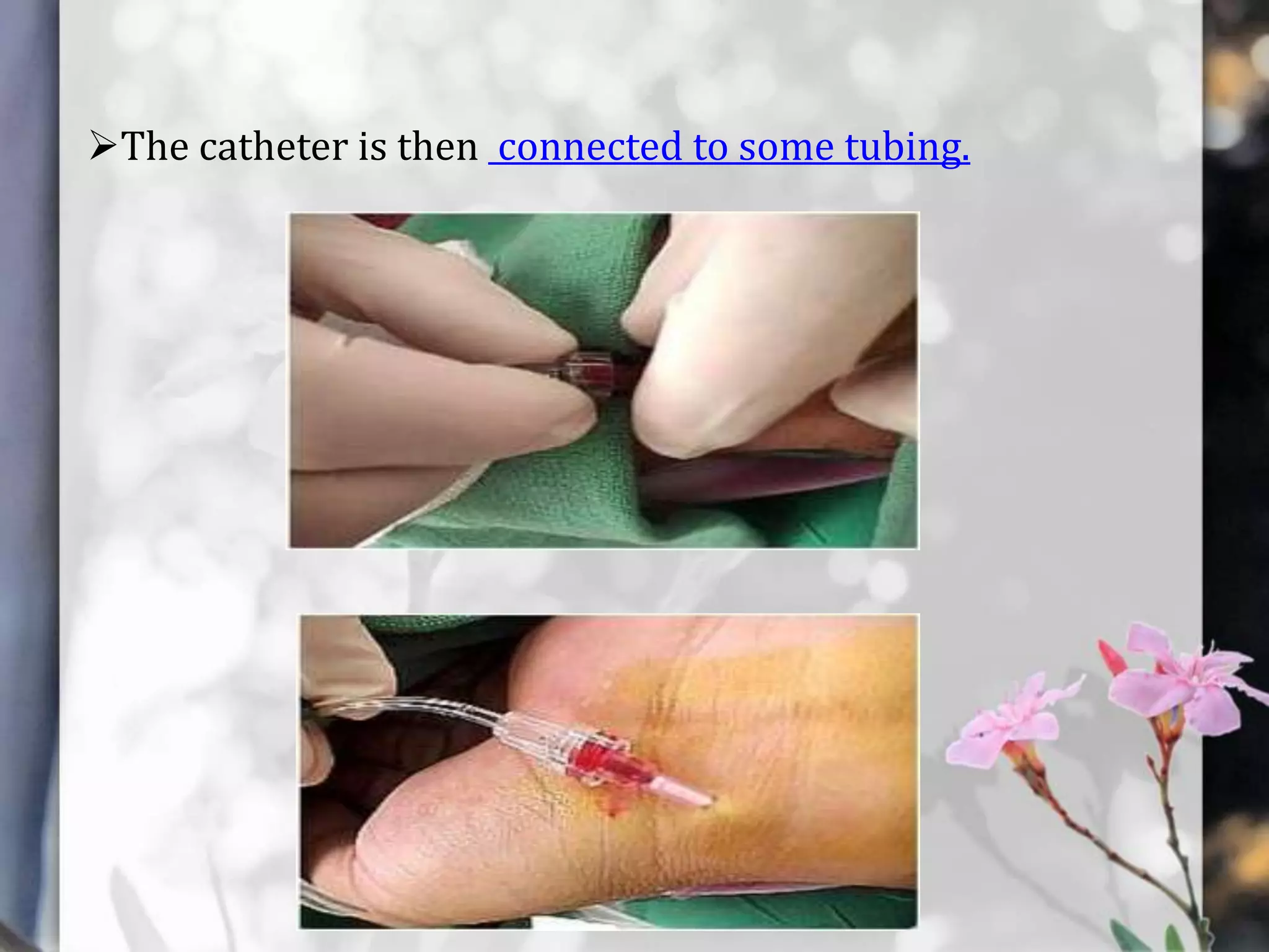 The catheter is then connected to some tubing.

 