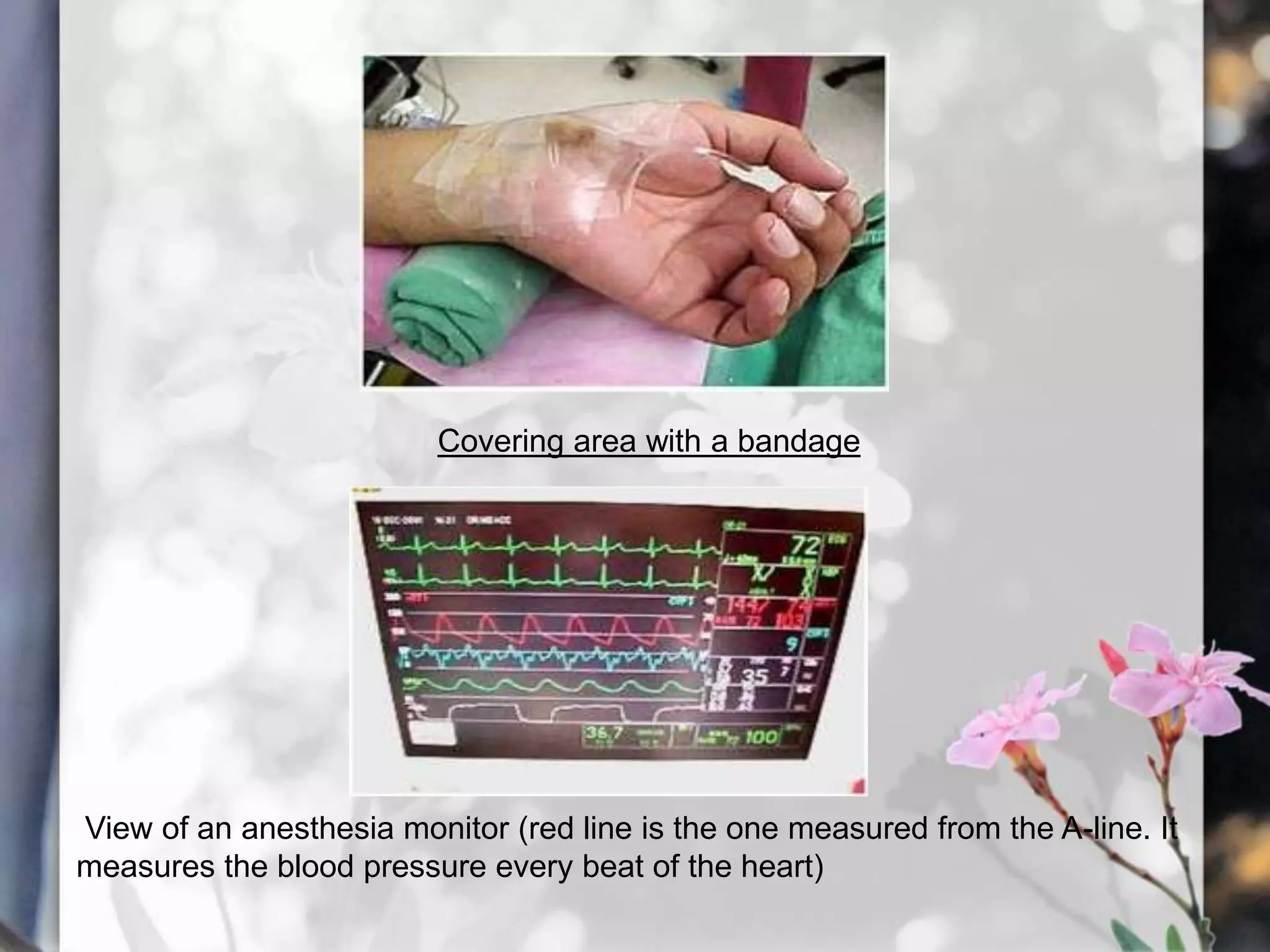 Covering area with a bandage

View of an anesthesia monitor (red line is the one measured from the A-line. It
measures the blood pressure every beat of the heart)

 