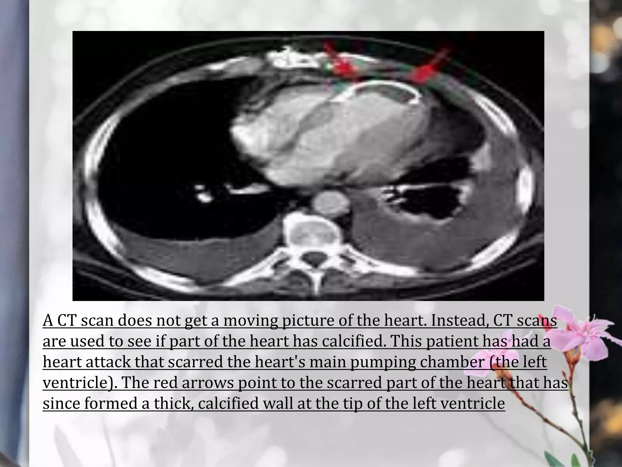 A CT scan does not get a moving picture of the heart. Instead, CT scans
are used to see if part of the heart has calcified. This patient has had a
heart attack that scarred the heart's main pumping chamber (the left
ventricle). The red arrows point to the scarred part of the heart that has
since formed a thick, calcified wall at the tip of the left ventricle

 