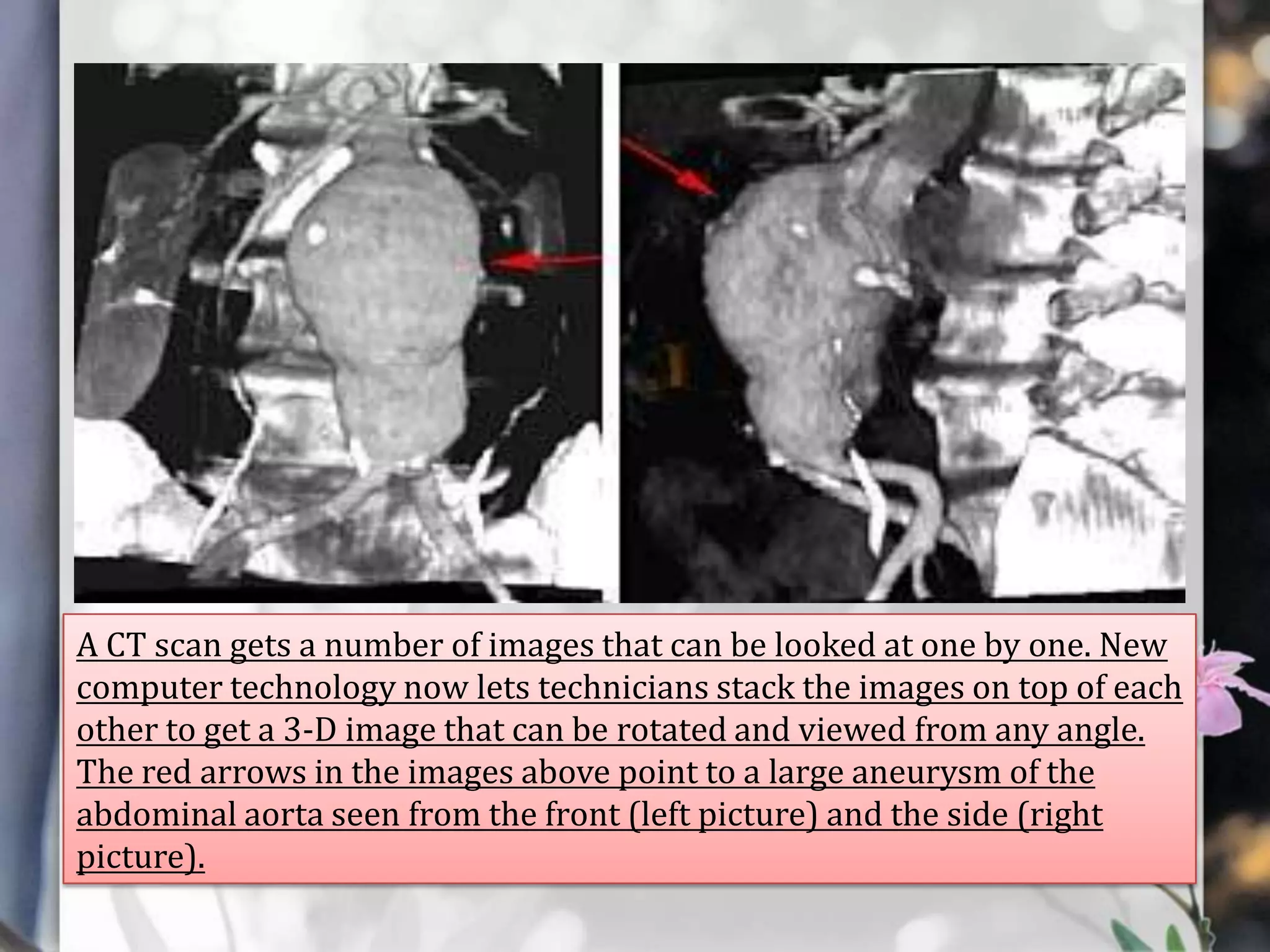 A CT scan gets a number of images that can be looked at one by one. New
computer technology now lets technicians stack the images on top of each
other to get a 3-D image that can be rotated and viewed from any angle.
The red arrows in the images above point to a large aneurysm of the
abdominal aorta seen from the front (left picture) and the side (right
picture).

 