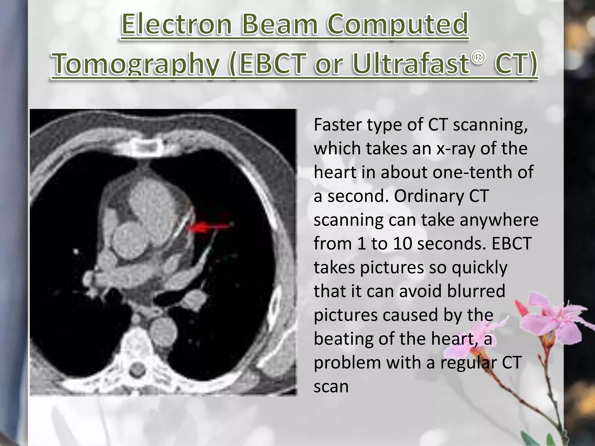 Faster type of CT scanning,
which takes an x-ray of the
heart in about one-tenth of
a second. Ordinary CT
scanning can take anywhere
from 1 to 10 seconds. EBCT
takes pictures so quickly
that it can avoid blurred
pictures caused by the
beating of the heart, a
problem with a regular CT
scan

 