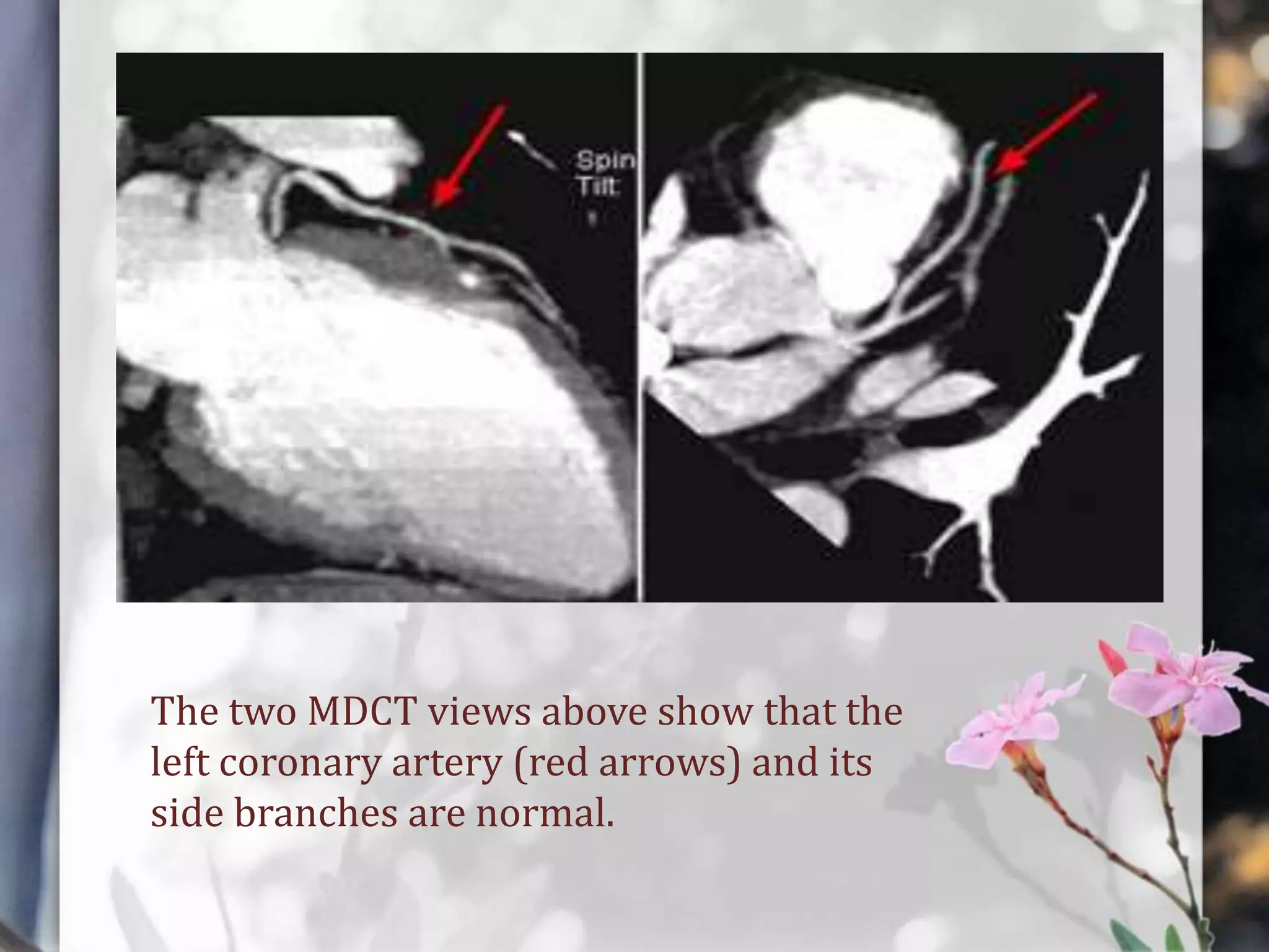 The two MDCT views above show that the
left coronary artery (red arrows) and its
side branches are normal.

 