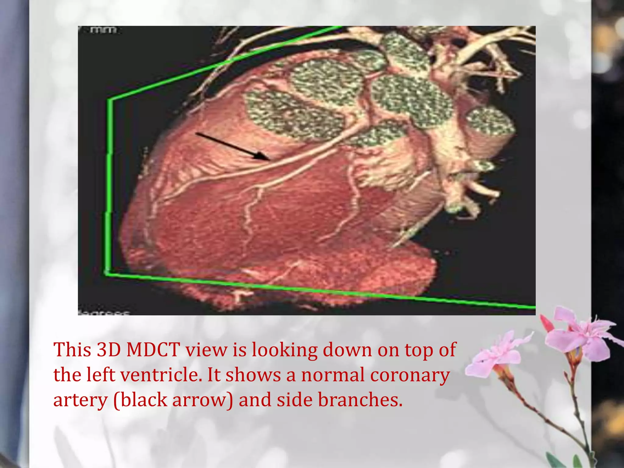 This 3D MDCT view is looking down on top of
the left ventricle. It shows a normal coronary
artery (black arrow) and side branches.

 