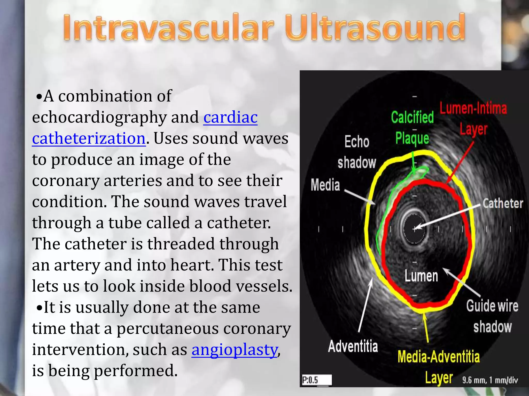 •A combination of
echocardiography and cardiac
catheterization. Uses sound waves
to produce an image of the
coronary arteries and to see their
condition. The sound waves travel
through a tube called a catheter.
The catheter is threaded through
an artery and into heart. This test
lets us to look inside blood vessels.
•It is usually done at the same
time that a percutaneous coronary
intervention, such as angioplasty,
is being performed.

 