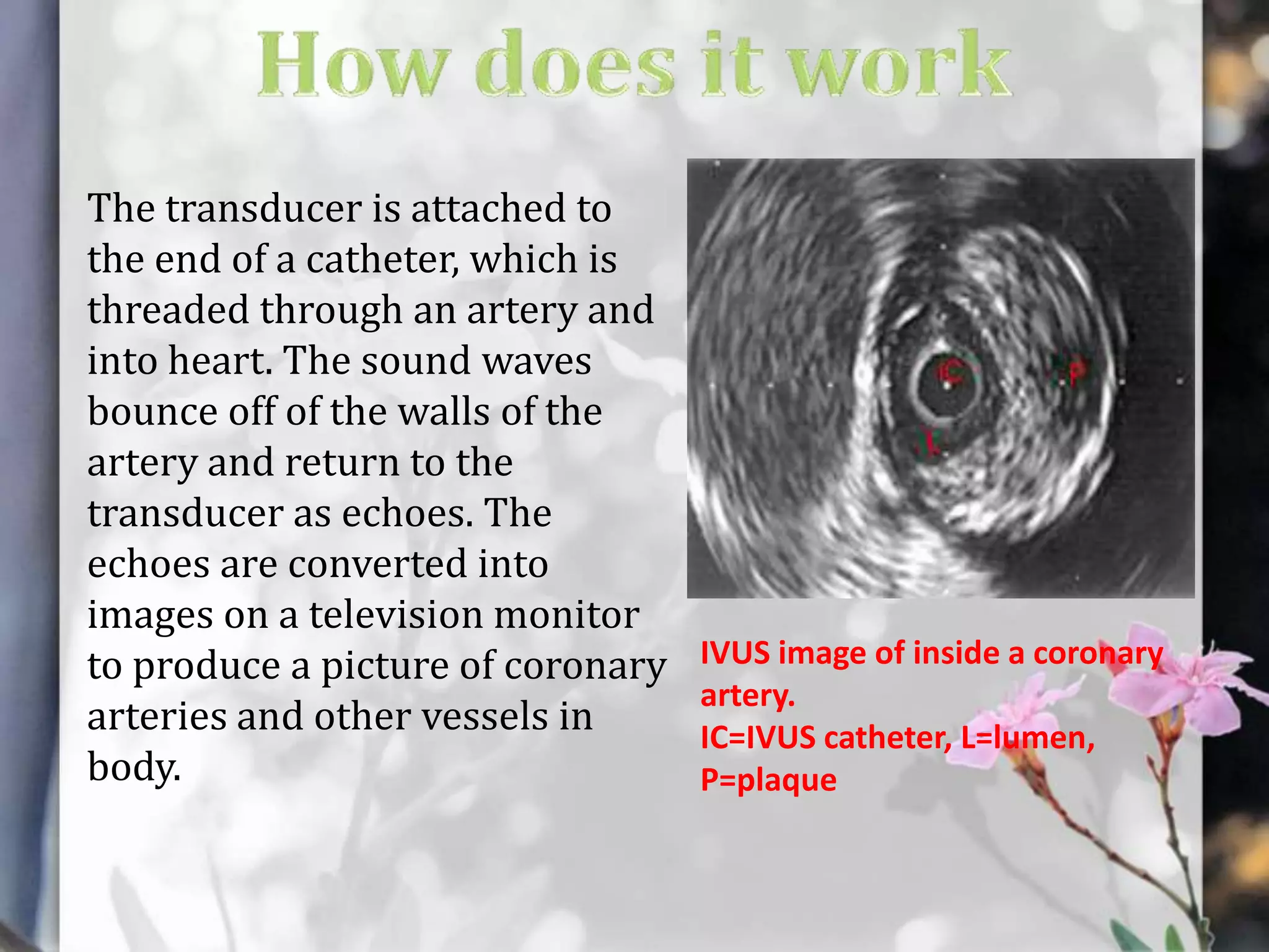 The transducer is attached to
the end of a catheter, which is
threaded through an artery and
into heart. The sound waves
bounce off of the walls of the
artery and return to the
transducer as echoes. The
echoes are converted into
images on a television monitor
to produce a picture of coronary
arteries and other vessels in
body.

IVUS image of inside a coronary
artery.
IC=IVUS catheter, L=lumen,
P=plaque

 