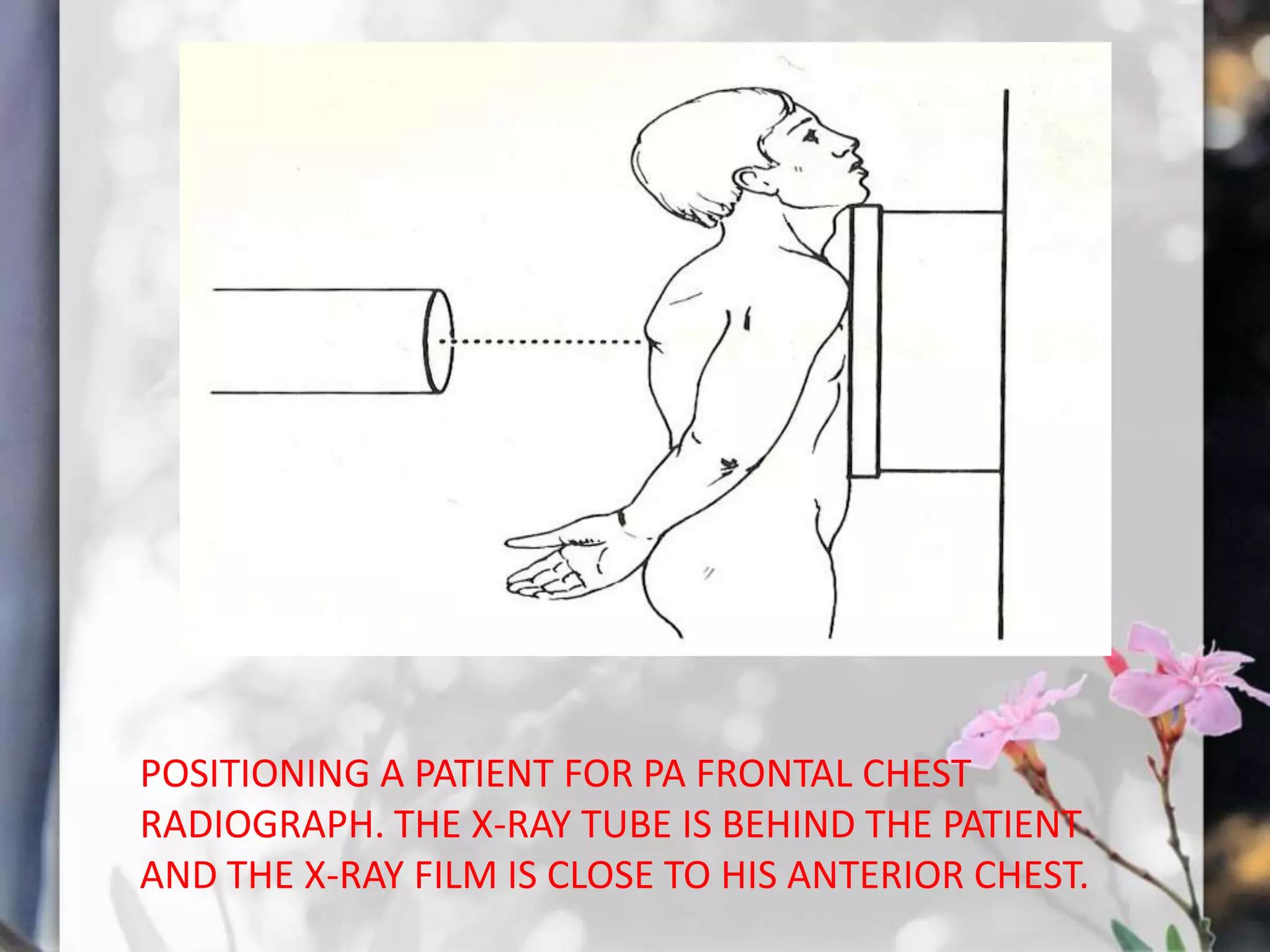 POSITIONING A PATIENT FOR PA FRONTAL CHEST
RADIOGRAPH. THE X-RAY TUBE IS BEHIND THE PATIENT
AND THE X-RAY FILM IS CLOSE TO HIS ANTERIOR CHEST.

 