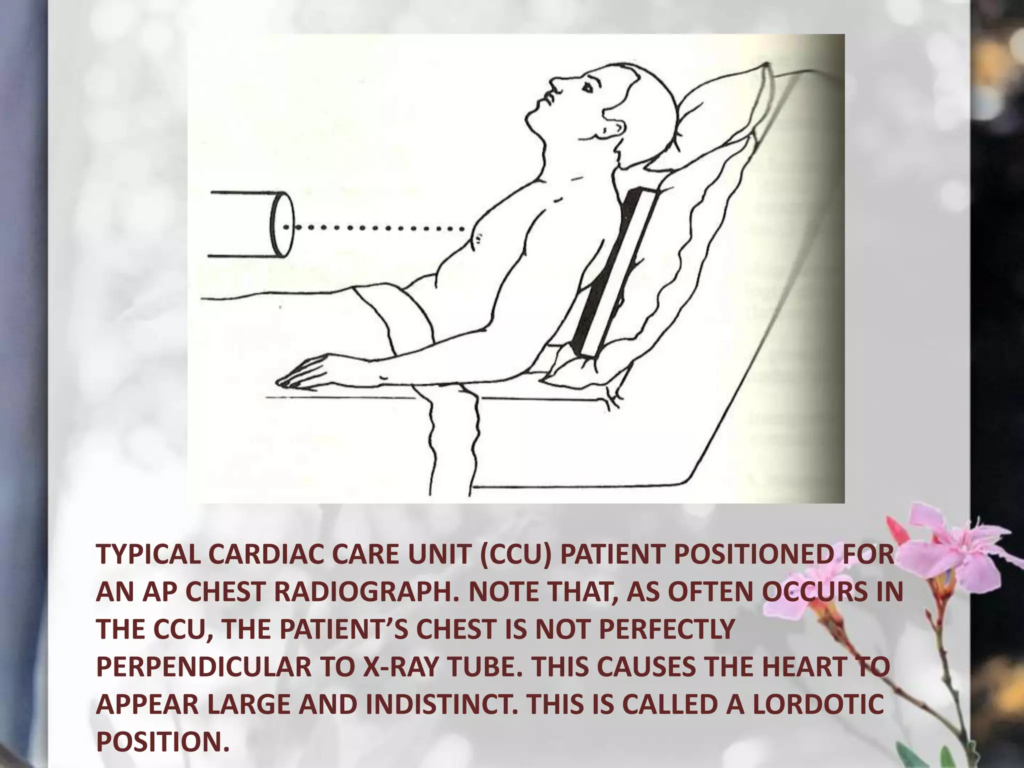 TYPICAL CARDIAC CARE UNIT (CCU) PATIENT POSITIONED FOR
AN AP CHEST RADIOGRAPH. NOTE THAT, AS OFTEN OCCURS IN
THE CCU, THE PATIENT’S CHEST IS NOT PERFECTLY
PERPENDICULAR TO X-RAY TUBE. THIS CAUSES THE HEART TO
APPEAR LARGE AND INDISTINCT. THIS IS CALLED A LORDOTIC
POSITION.

 