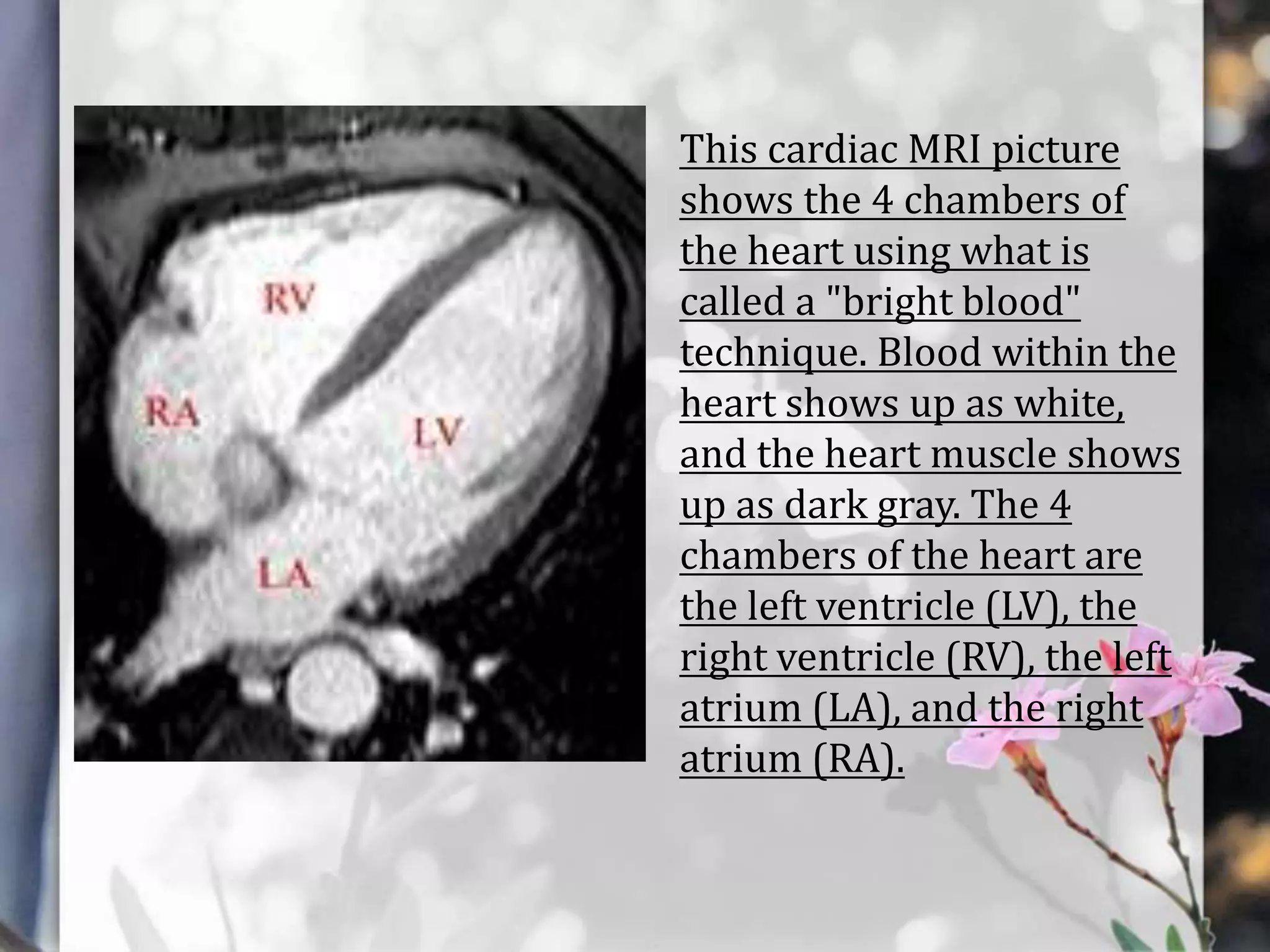 This cardiac MRI picture
shows the 4 chambers of
the heart using what is
called a "bright blood"
technique. Blood within the
heart shows up as white,
and the heart muscle shows
up as dark gray. The 4
chambers of the heart are
the left ventricle (LV), the
right ventricle (RV), the left
atrium (LA), and the right
atrium (RA).

 