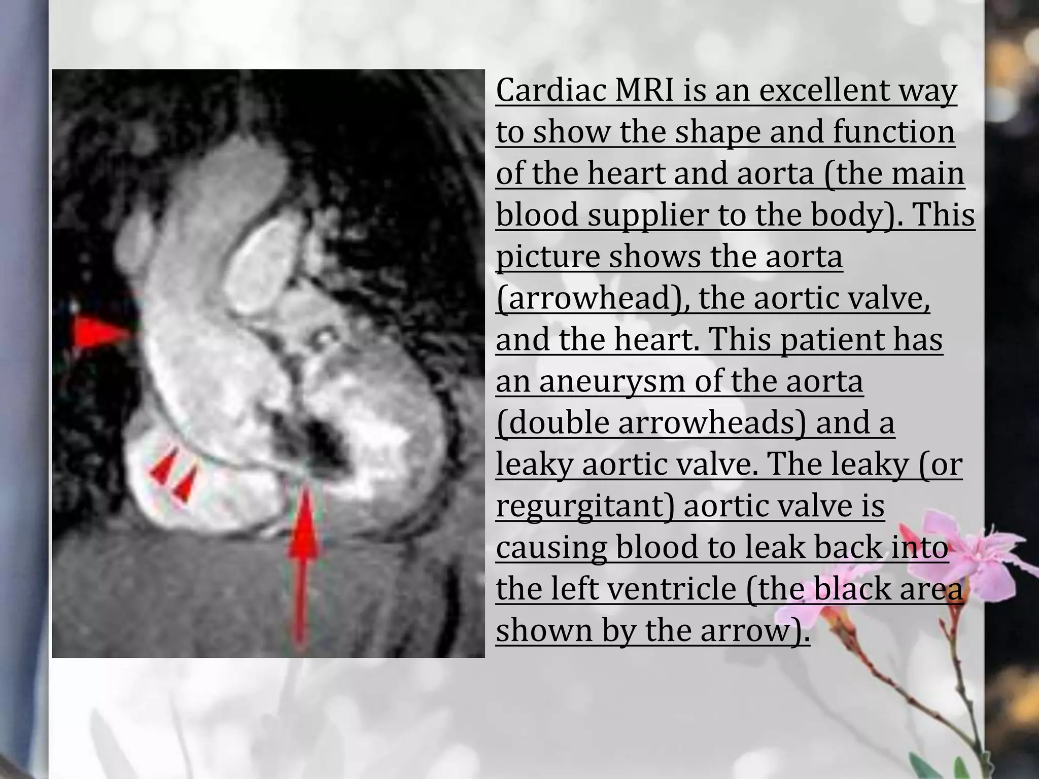 Cardiac MRI is an excellent way
to show the shape and function
of the heart and aorta (the main
blood supplier to the body). This
picture shows the aorta
(arrowhead), the aortic valve,
and the heart. This patient has
an aneurysm of the aorta
(double arrowheads) and a
leaky aortic valve. The leaky (or
regurgitant) aortic valve is
causing blood to leak back into
the left ventricle (the black area
shown by the arrow).

 