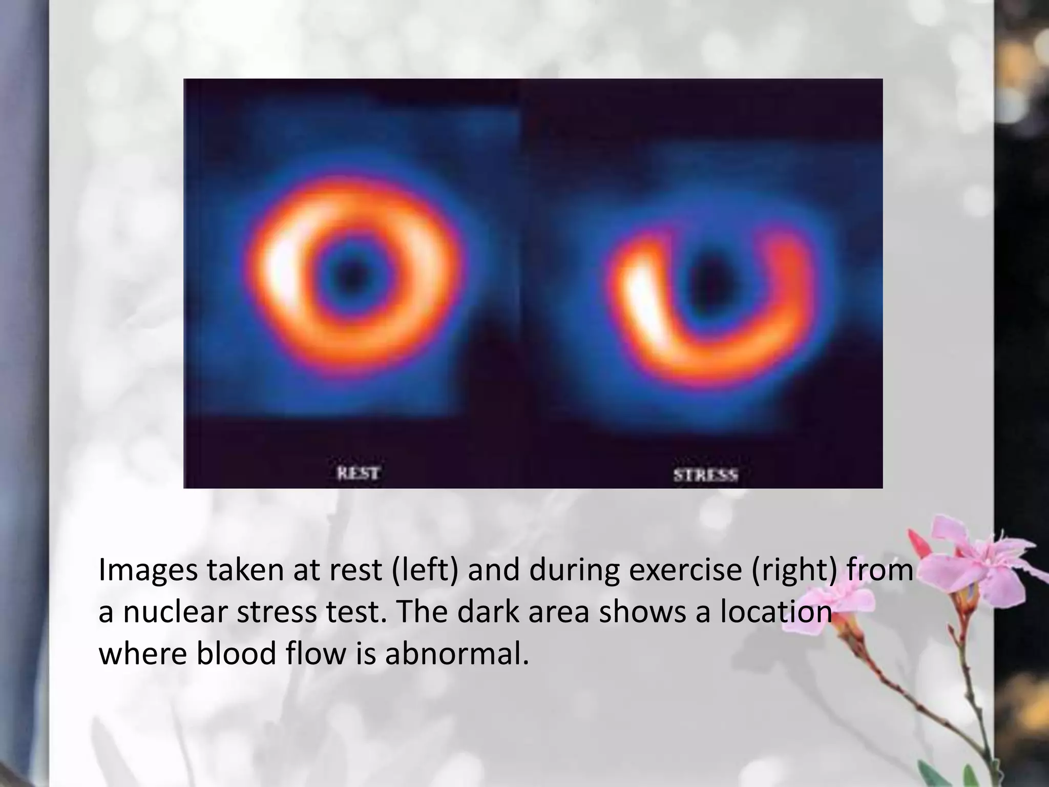 Images taken at rest (left) and during exercise (right) from
a nuclear stress test. The dark area shows a location
where blood flow is abnormal.

 
