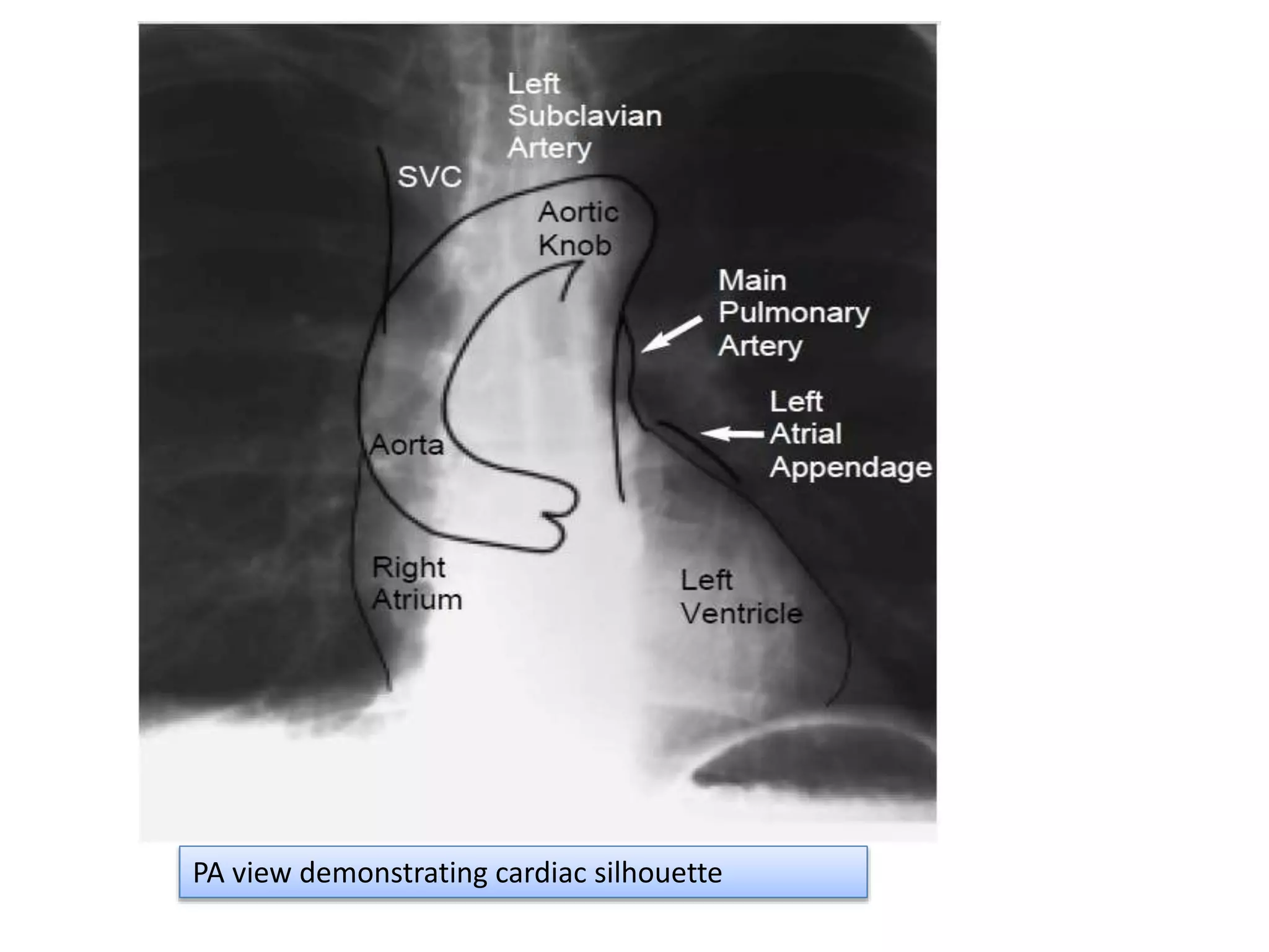 Radiographic approach to cardiac enlargement | PPTX