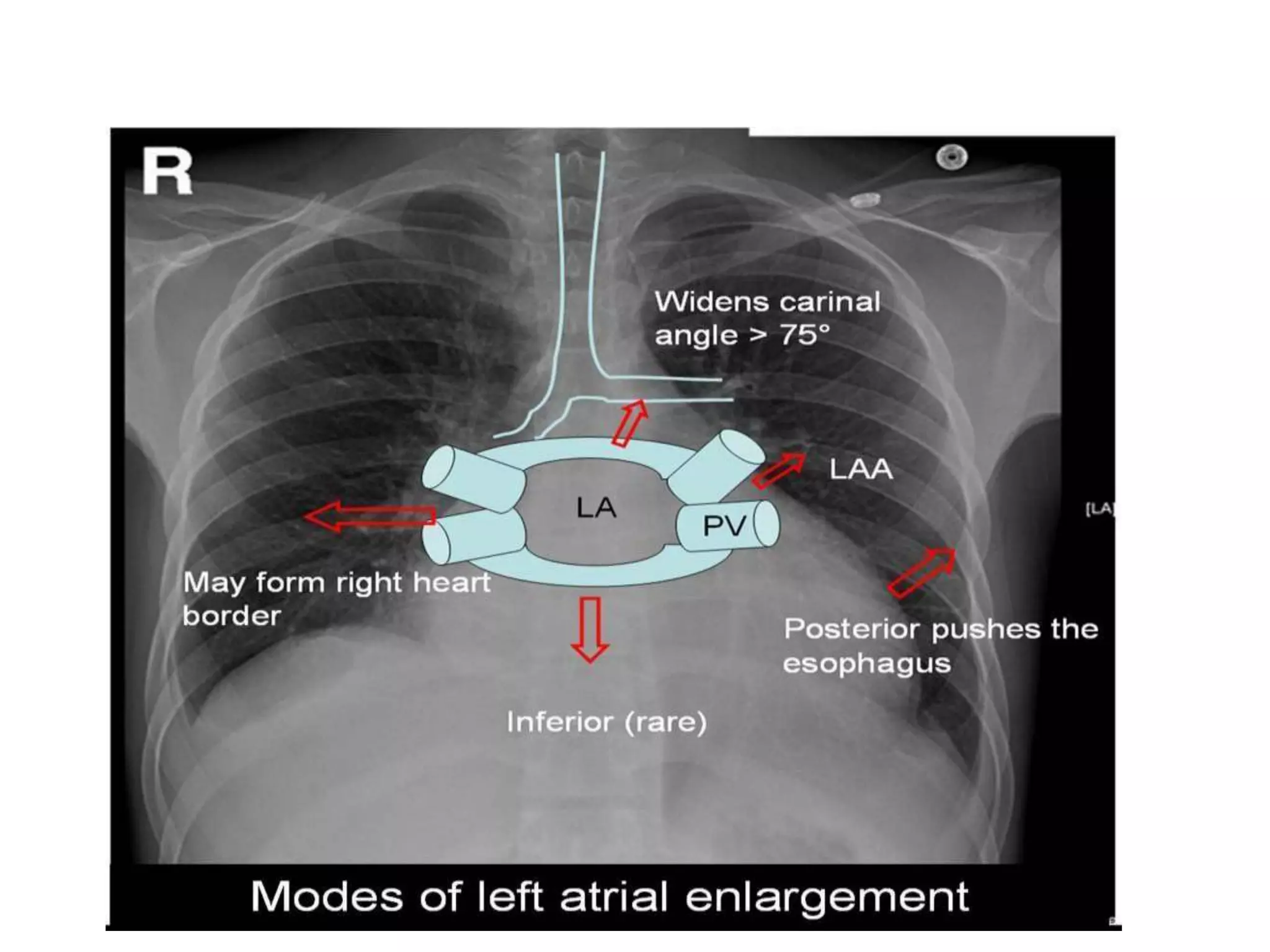 Radiographic approach to cardiac enlargement | PPTX