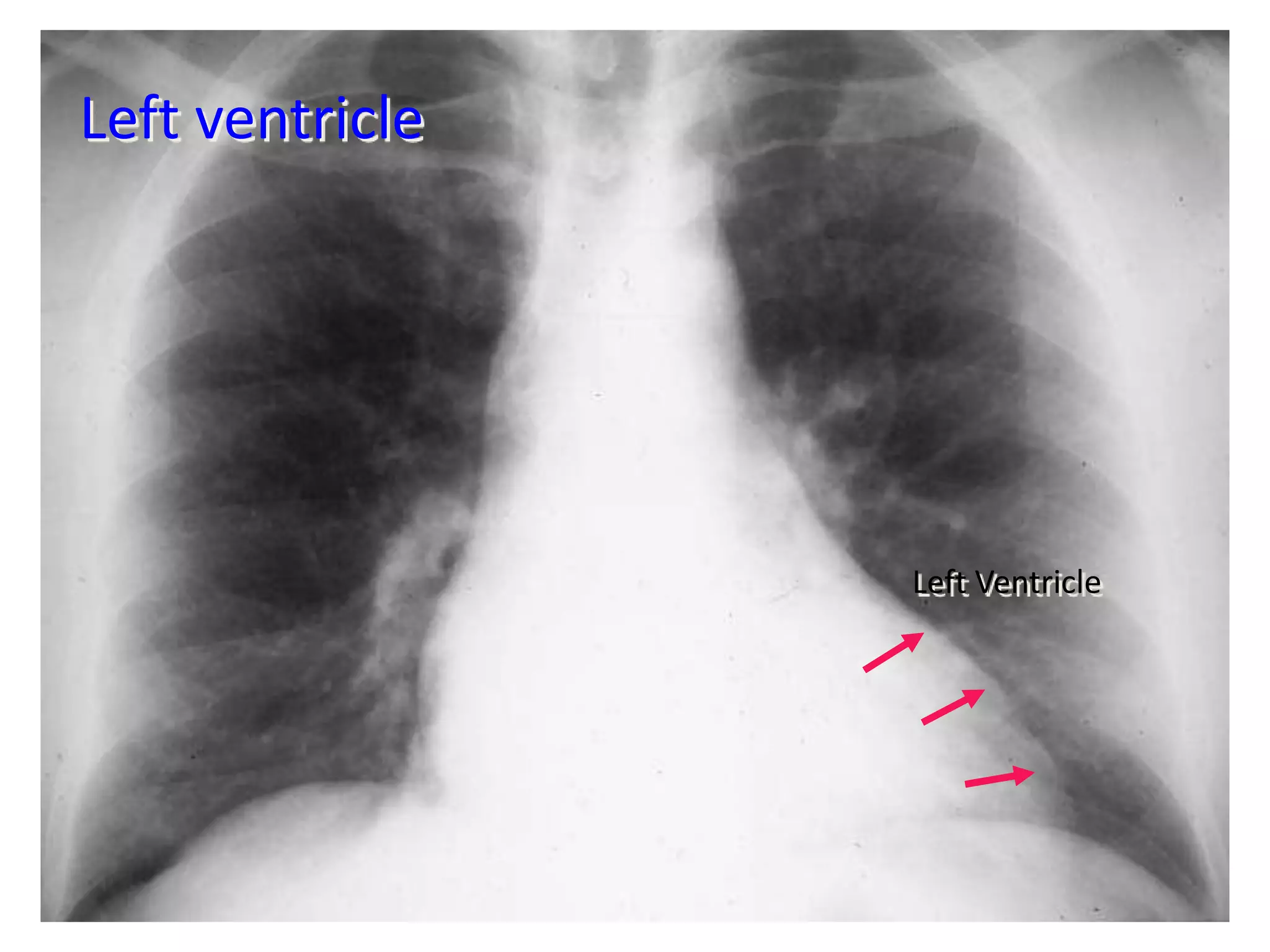 Radiographic approach to cardiac enlargement | PPTX