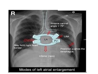 Radiographic approach to cardiac enlargement | PPTX