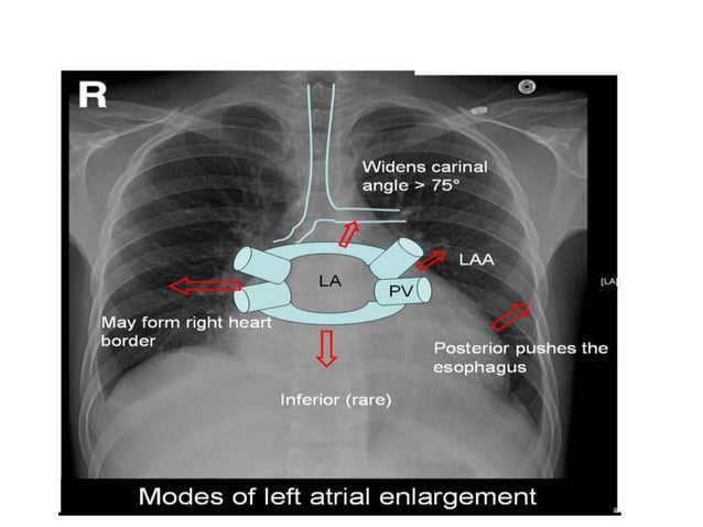 Radiographic approach to cardiac enlargement | PPTX | Heart and ...