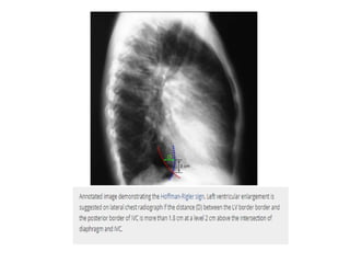 Radiographic approach to cardiac enlargement | PPTX