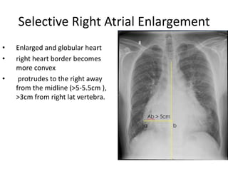 Radiographic approach to cardiac enlargement | PPTX