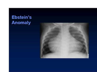 Radiographic approach to cardiac enlargement | PPTX