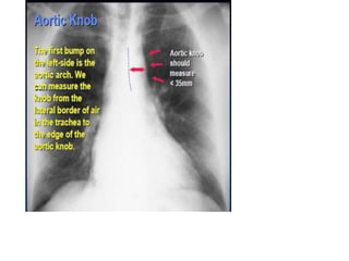 Radiographic approach to cardiac enlargement | PPTX