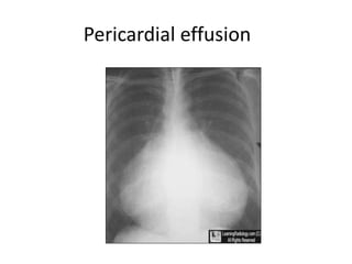 Radiographic approach to cardiac enlargement | PPTX