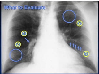 Radiographic approach to cardiac enlargement | PPTX