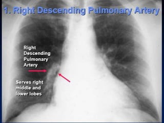 Radiographic approach to cardiac enlargement | PPTX
