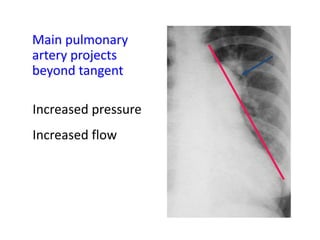 Radiographic approach to cardiac enlargement | PPTX