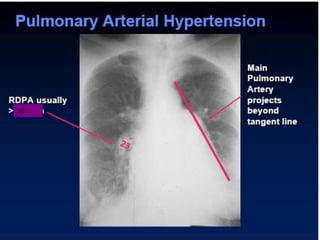 Radiographic approach to cardiac enlargement | PPTX