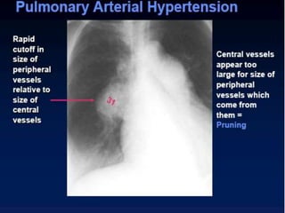Radiographic approach to cardiac enlargement | PPTX
