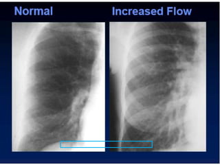 Radiographic approach to cardiac enlargement | PPTX