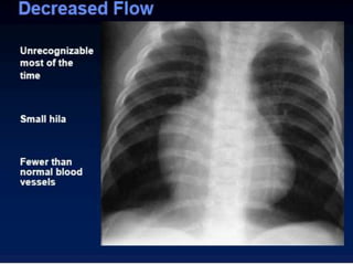 Radiographic approach to cardiac enlargement | PPTX