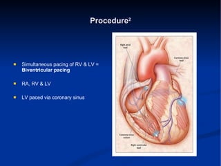 Procedure 2 Simultaneous pacing of RV & LV =  Biventricular pacing RA, RV & LV  LV paced via coronary sinus 