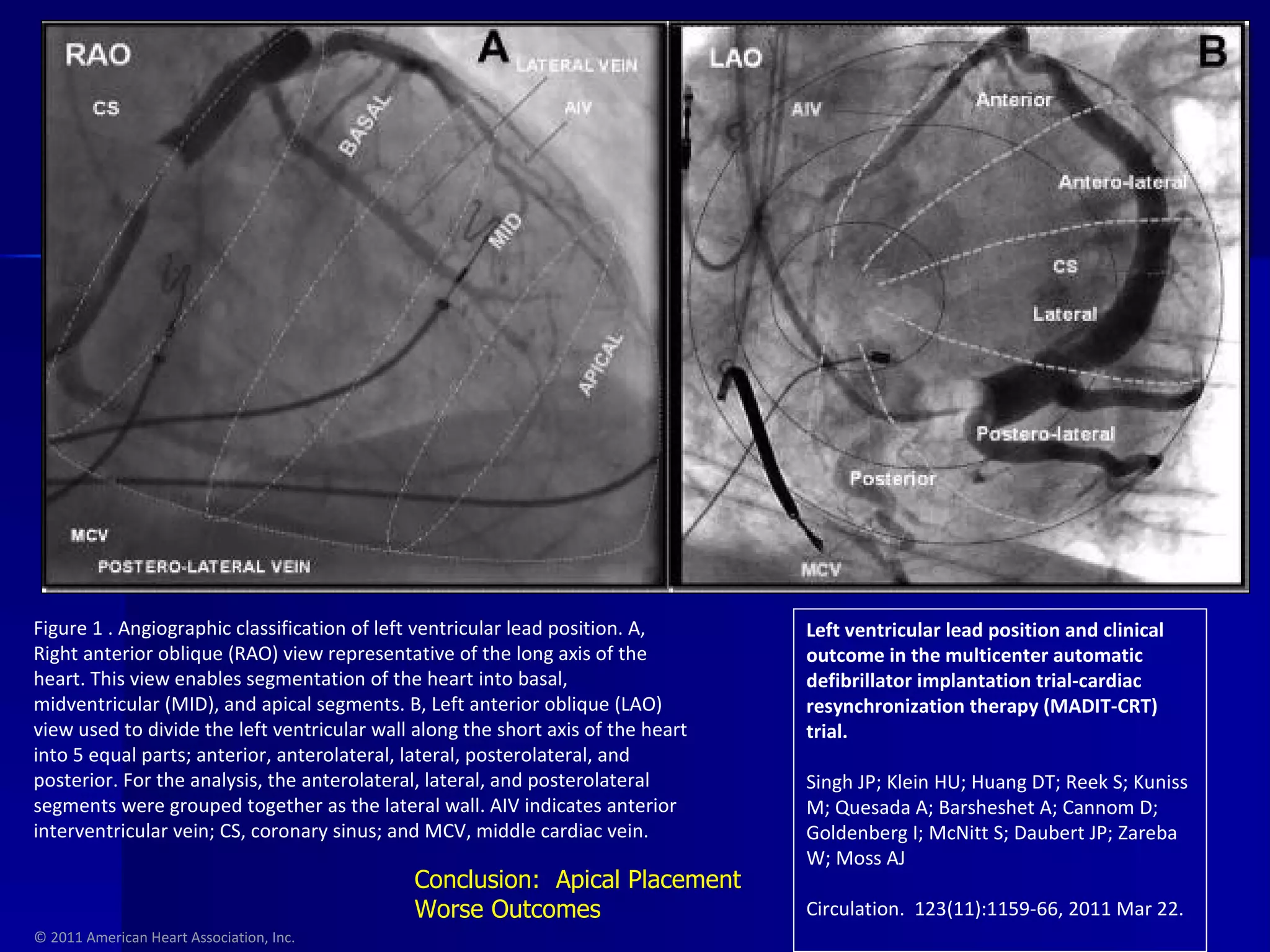 © 2011 American Heart Association, Inc. Left ventricular lead position and clinical outcome in the multicenter automatic defibrillator implantation trial-cardiac resynchronization therapy (MADIT-CRT) trial. Singh JP; Klein HU; Huang DT; Reek S; Kuniss M; Quesada A; Barsheshet A; Cannom D; Goldenberg I; McNitt S; Daubert JP; Zareba W; Moss AJ Circulation.  123(11):1159-66, 2011 Mar 22. Figure 1 . Angiographic classification of left ventricular lead position. A, Right anterior oblique (RAO) view representative of the long axis of the heart. This view enables segmentation of the heart into basal, midventricular (MID), and apical segments. B, Left anterior oblique (LAO) view used to divide the left ventricular wall along the short axis of the heart into 5 equal parts; anterior, anterolateral, lateral, posterolateral, and posterior. For the analysis, the anterolateral, lateral, and posterolateral segments were grouped together as the lateral wall. AIV indicates anterior interventricular vein; CS, coronary sinus; and MCV, middle cardiac vein. Conclusion:  Apical Placement Worse Outcomes 