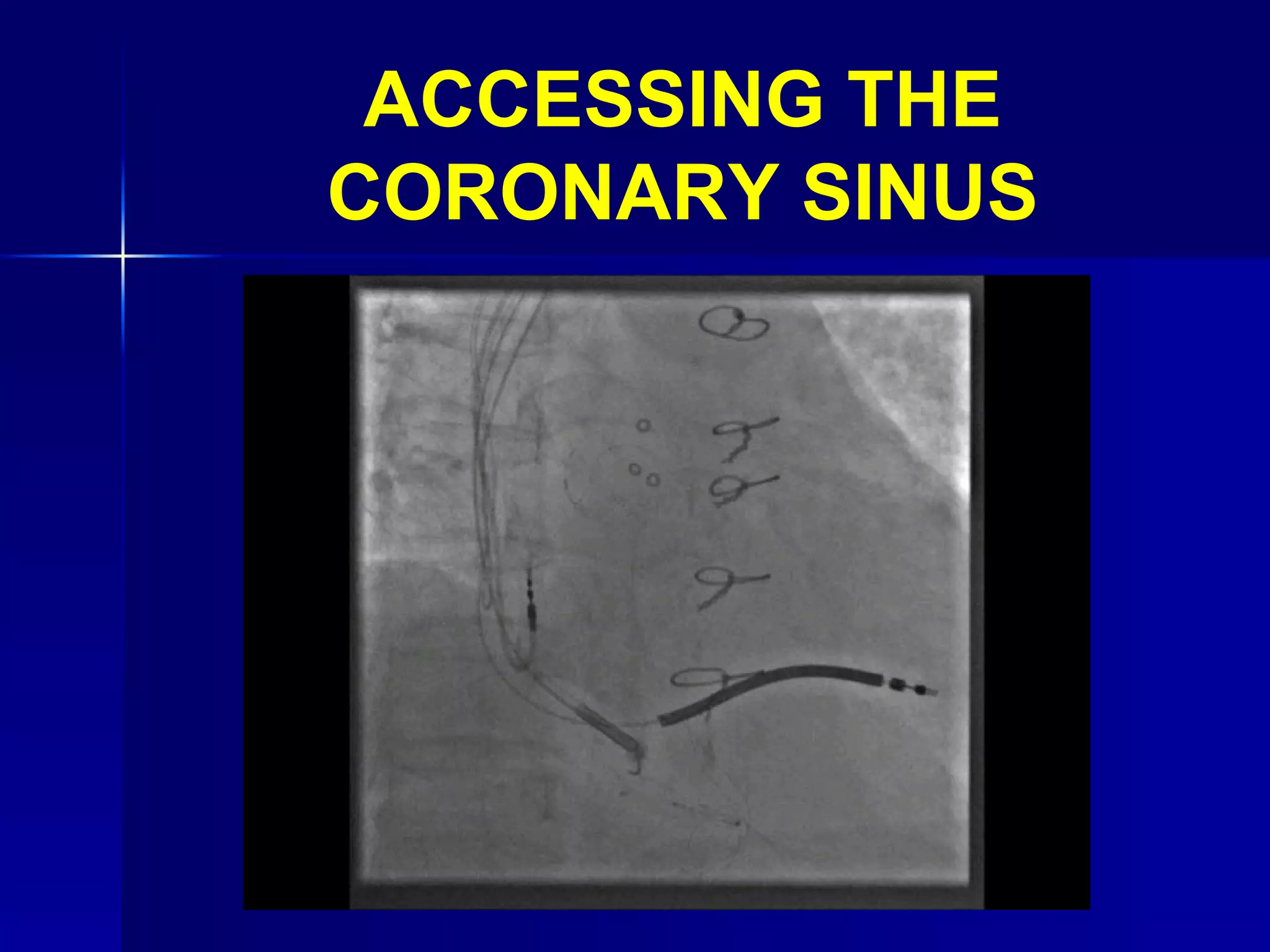 ACCESSING THE CORONARY SINUS 