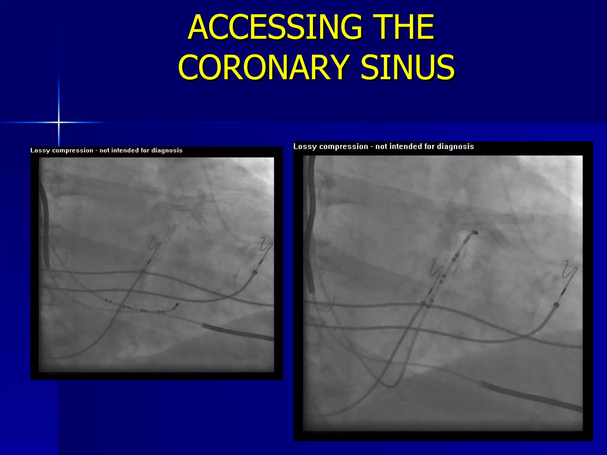 ACCESSING THE  CORONARY SINUS 