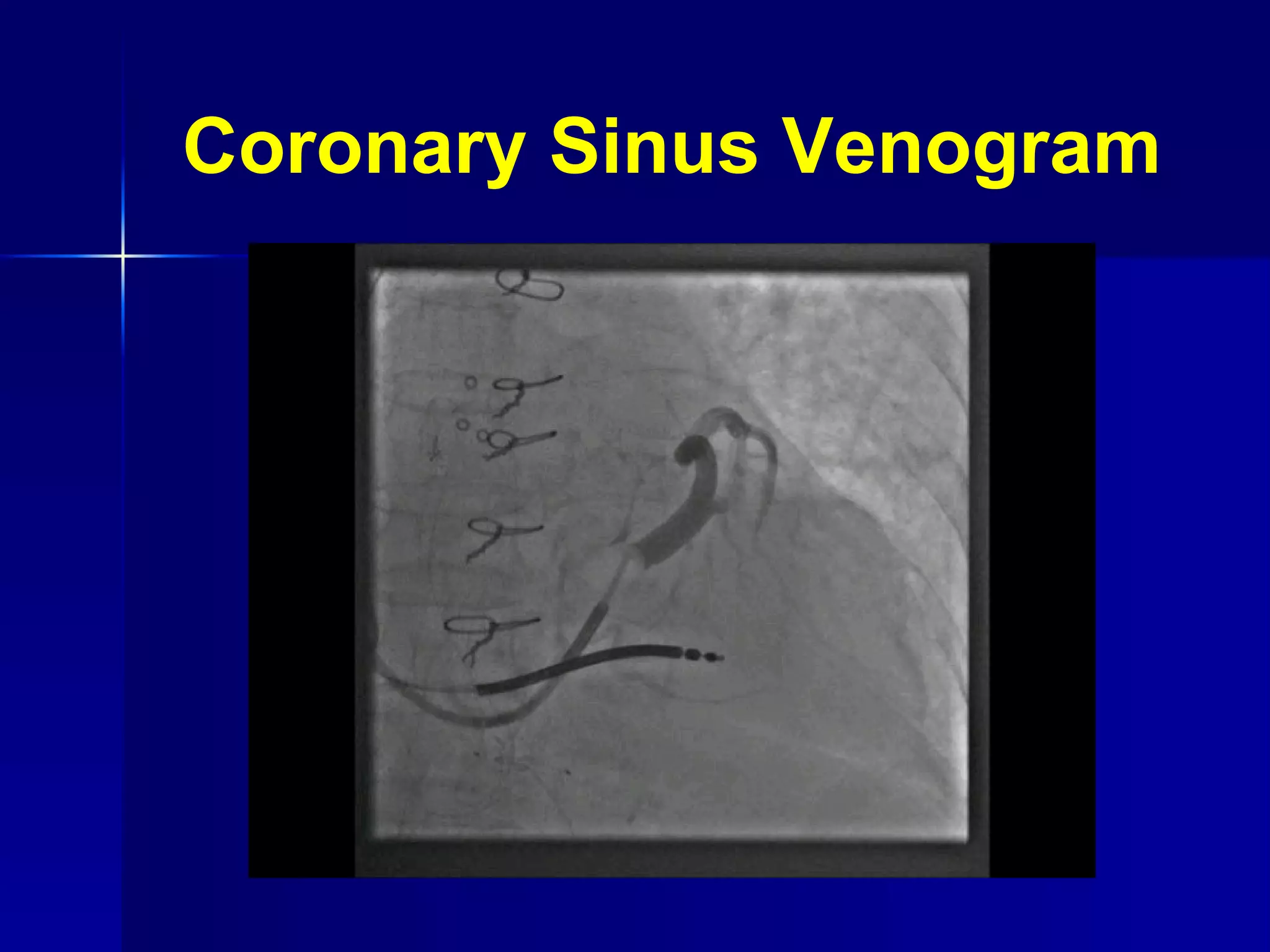 Coronary Sinus Venogram 