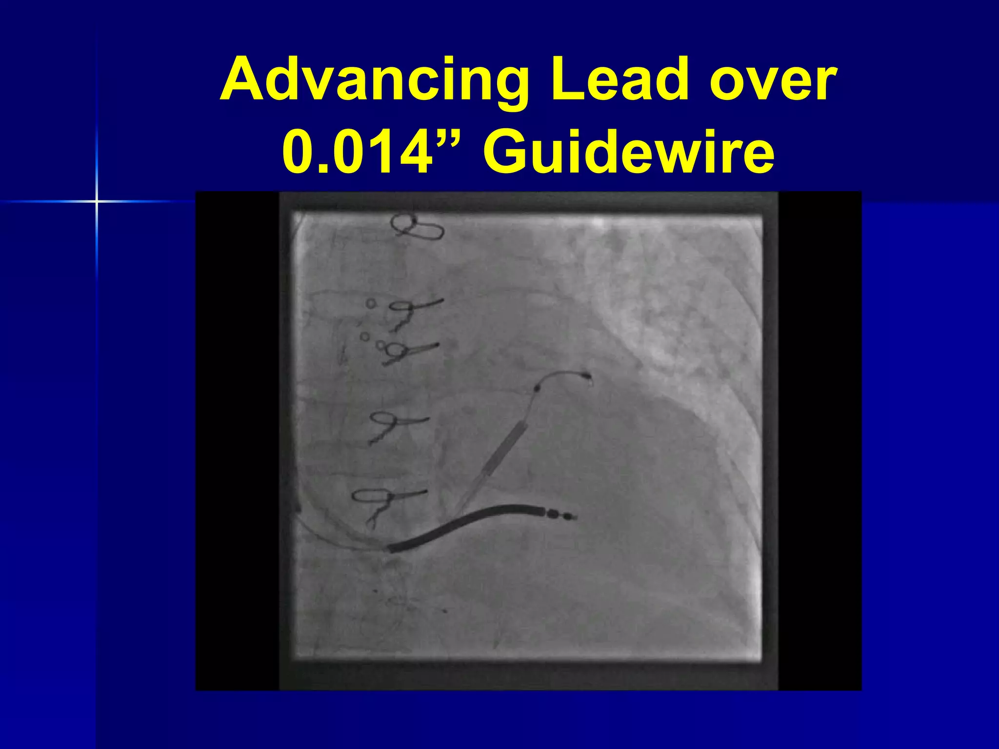 Advancing Lead over 0.014” Guidewire 