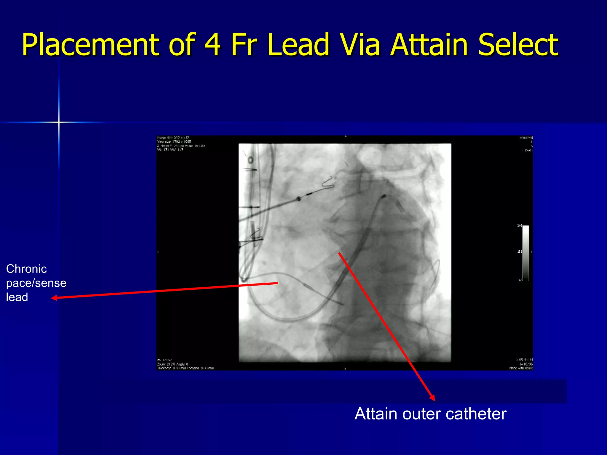 Placement of 4 Fr Lead Via Attain Select Attain outer catheter Chronic pace/sense lead 