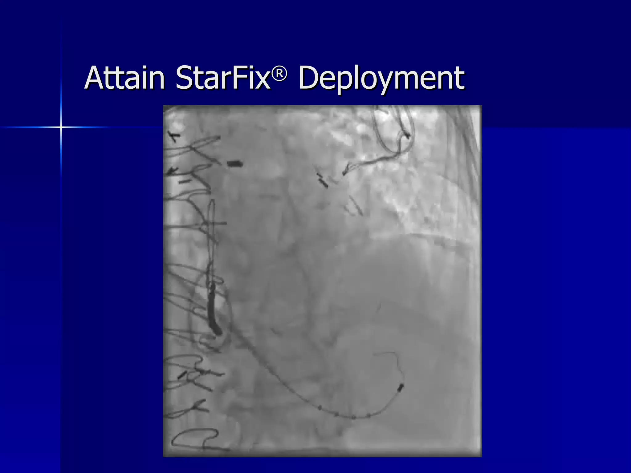 Attain StarFix ®  Deployment 