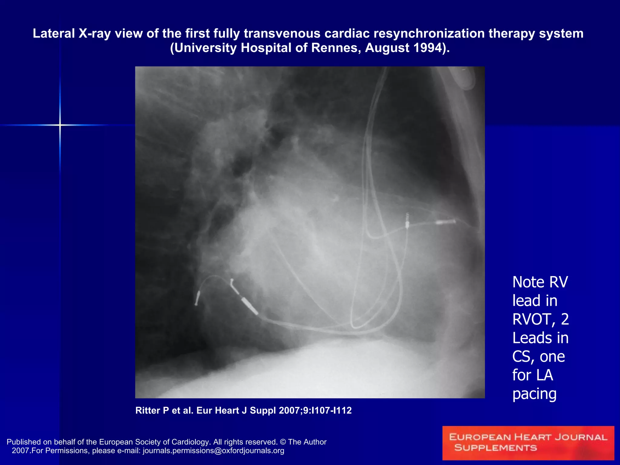 Lateral X-ray view of the first fully transvenous cardiac resynchronization therapy system  (University Hospital of Rennes, August 1994). Ritter P et al. Eur Heart J Suppl 2007;9:I107-I112 Published on behalf of the European Society of Cardiology. All rights reserved. © The Author 2007.For Permissions, please e-mail: journals.permissions@oxfordjournals.org Note RV lead in RVOT, 2 Leads in CS, one for LA pacing 