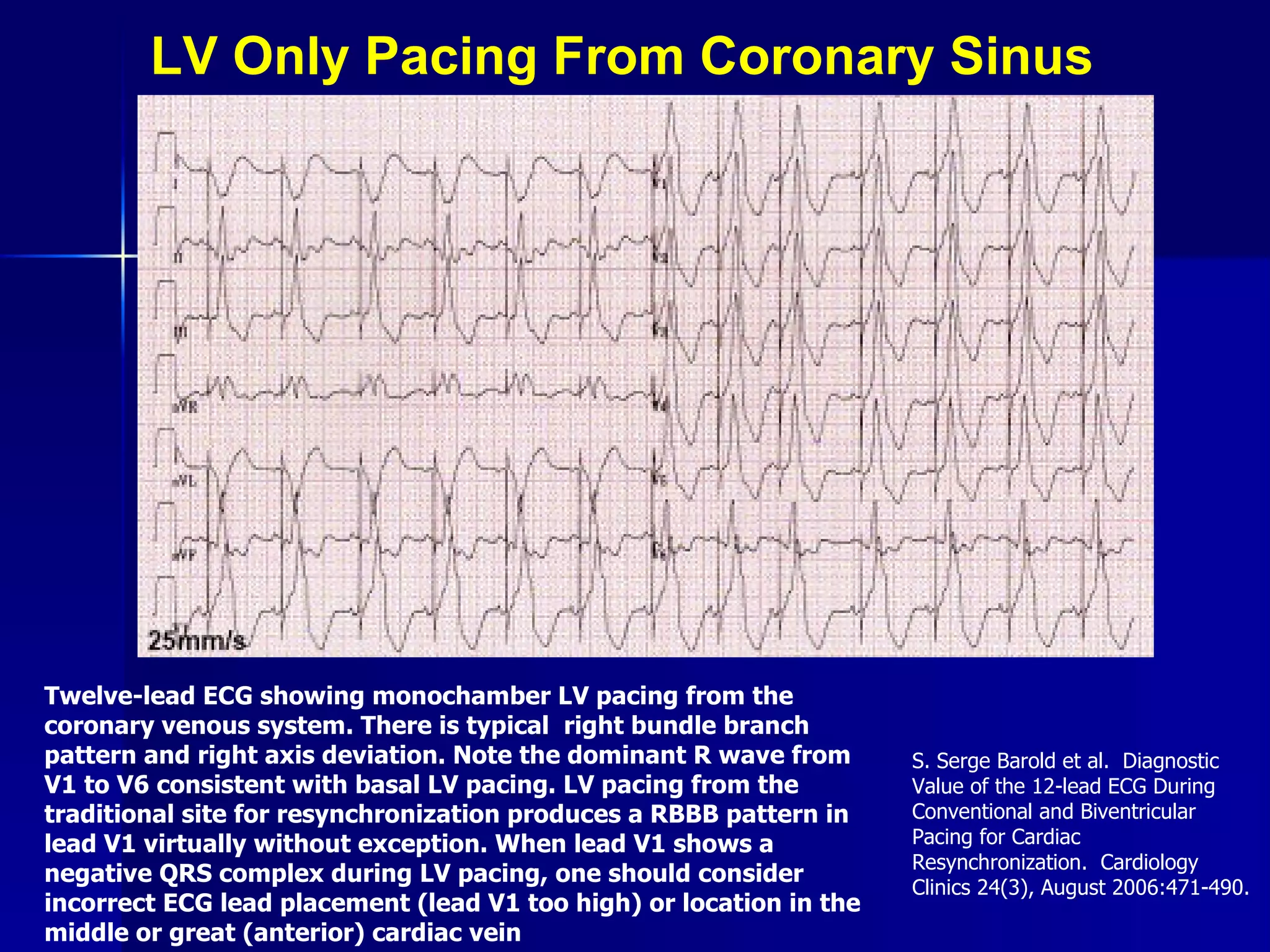 LV Only Pacing From Coronary Sinus Twelve-lead ECG showing monochamber LV pacing from the coronary venous system. There is typical  right bundle branch pattern and right axis deviation. Note the dominant R wave from V1 to V6 consistent with basal LV pacing. LV pacing from the traditional site for resynchronization produces a RBBB pattern in lead V1 virtually without exception. When lead V1 shows a negative QRS complex during LV pacing, one should consider incorrect ECG lead placement (lead V1 too high) or location in the middle or great (anterior) cardiac vein S. Serge Barold et al.  Diagnostic Value of the 12-lead ECG During Conventional and Biventricular Pacing for Cardiac Resynchronization.  Cardiology Clinics 24(3), August 2006:471-490. 