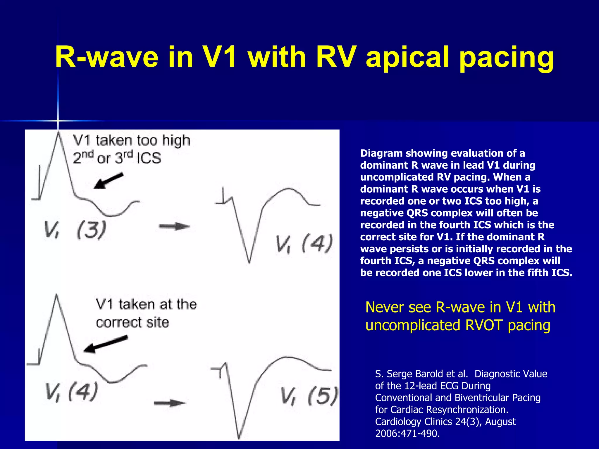 R-wave in V1 with RV apical pacing Diagram showing evaluation of a dominant R wave in lead V1 during uncomplicated RV pacing. When a dominant R wave occurs when V1 is recorded one or two ICS too high, a negative QRS complex will often be recorded in the fourth ICS which is the correct site for V1. If the dominant R wave persists or is initially recorded in the fourth ICS, a negative QRS complex will be recorded one ICS lower in the fifth ICS.   Never see R-wave in V1 with uncomplicated RVOT pacing S. Serge Barold et al.  Diagnostic Value of the 12-lead ECG During Conventional and Biventricular Pacing for Cardiac Resynchronization.  Cardiology Clinics 24(3), August 2006:471-490. 