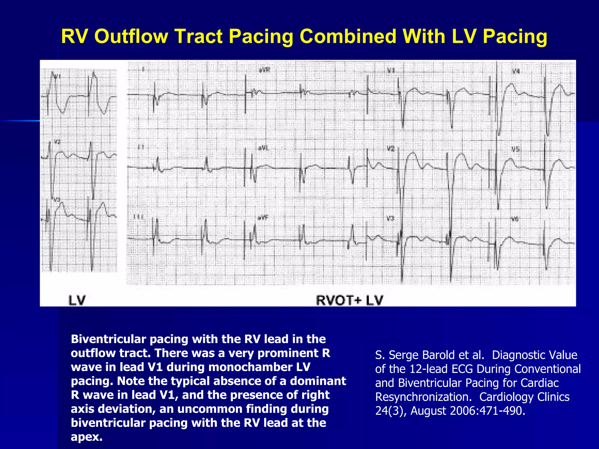 RV Outflow Tract Pacing Combined With LV Pacing Biventricular pacing with the RV lead in the outflow tract. There was a very prominent R wave in lead V1 during monochamber LV pacing. Note the typical absence of a dominant R wave in lead V1, and the presence of right axis deviation, an uncommon finding during biventricular pacing with the RV lead at the apex.   S. Serge Barold et al.  Diagnostic Value of the 12-lead ECG During Conventional and Biventricular Pacing for Cardiac Resynchronization.  Cardiology Clinics 24(3), August 2006:471-490. 